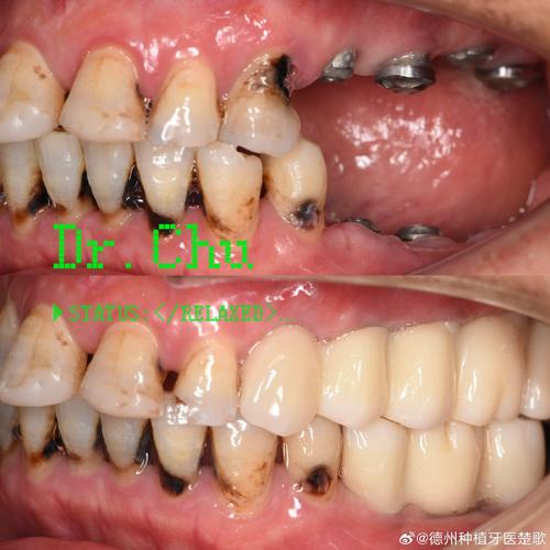 种牙上颌窦提升手术过程到底疼不疼？-图3