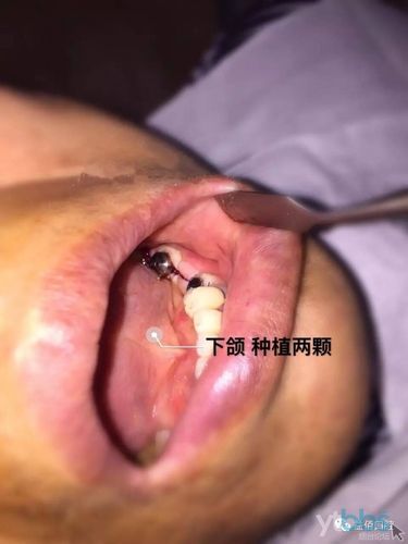 正规水激光种牙哪里可以做？求推荐靠谱地点-图2