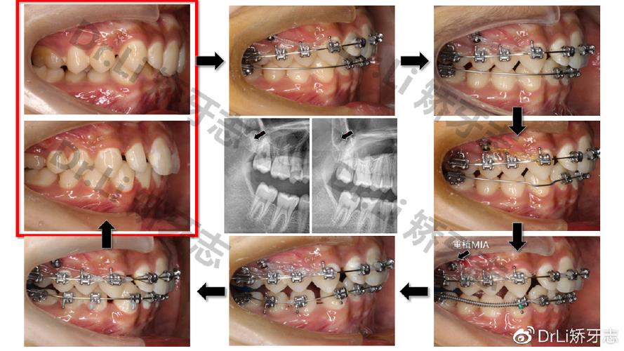 传统正畸磨牙远移的方法有哪些？如何操作？-图1