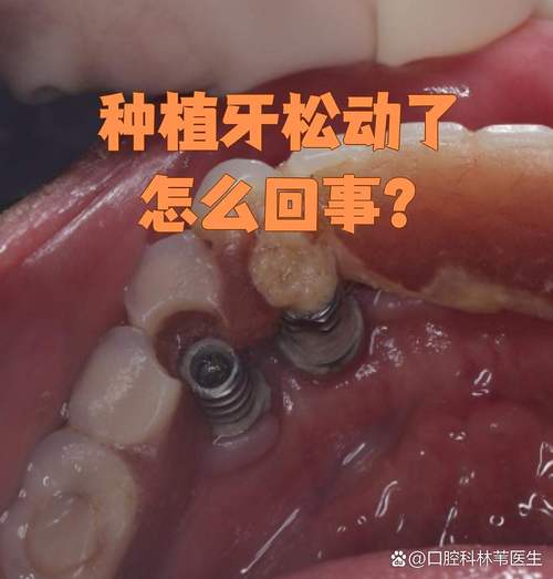 种牙后会不会松动?影响使用和寿命吗?-图2 种牙后会不会松动?影响使用和寿命吗?-图2
