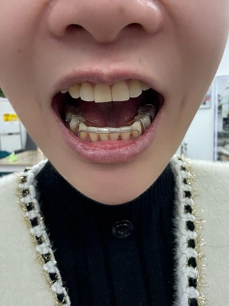 正畸中前牙缝隙关不上，是什么原因导致的？-图1