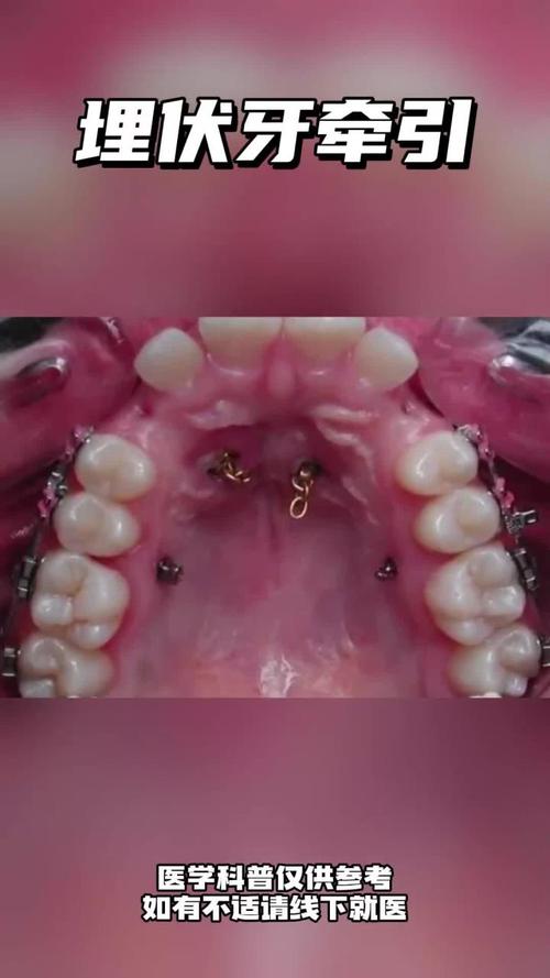牙齿牵引有哪些常用方法？哪种最合适？-图2