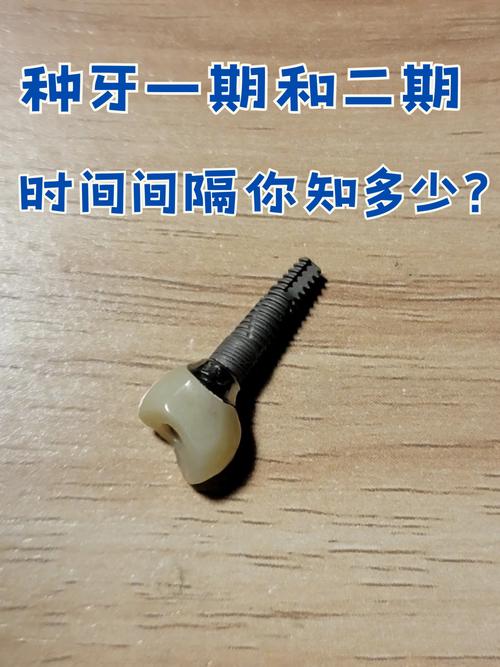 种牙埋件能用多久?使用寿命受哪些因素影响?-图1 种牙埋件能用多久?使用寿命受哪些因素影响?-图1