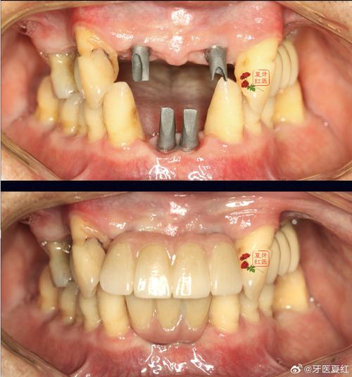 种牙后带牙冠视频，牙冠安装过程是怎样的？-图3