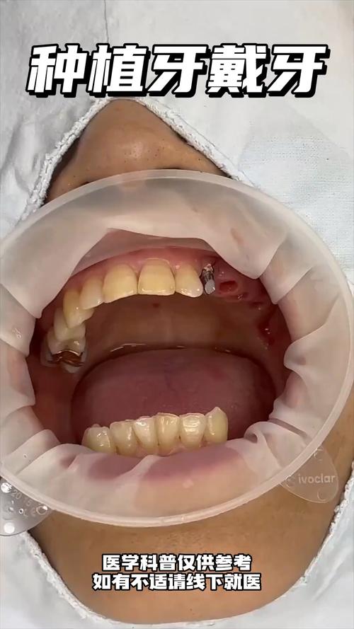种牙后带牙冠视频，牙冠安装过程是怎样的？-图1