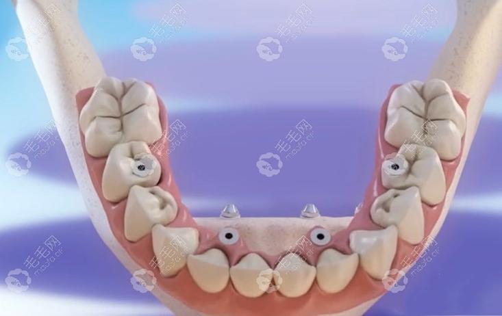 种牙后带牙冠视频，牙冠安装过程是怎样的？-图2