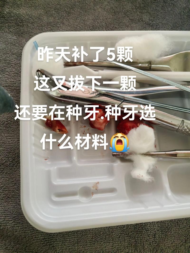 种牙常用哪些材质？安全耐用怎么选？-图1