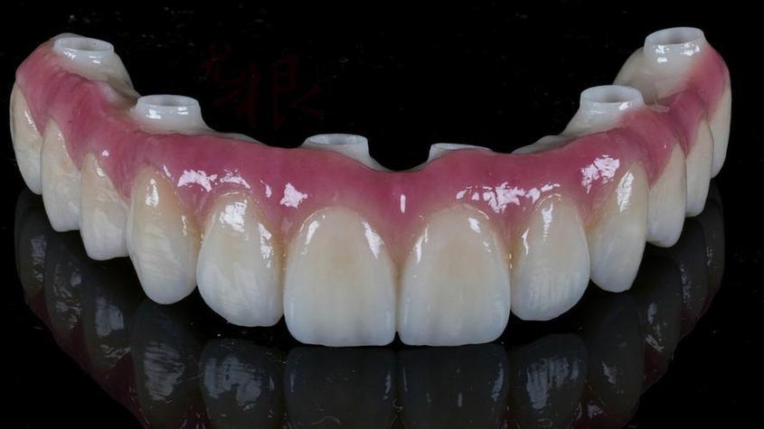 种牙常用哪些材质？安全耐用怎么选？-图3