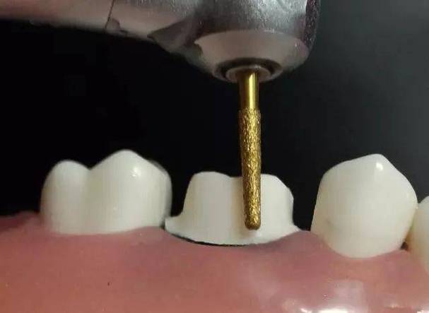 牙冠肩台预备方法的关键步骤与注意事项是什么？-图3