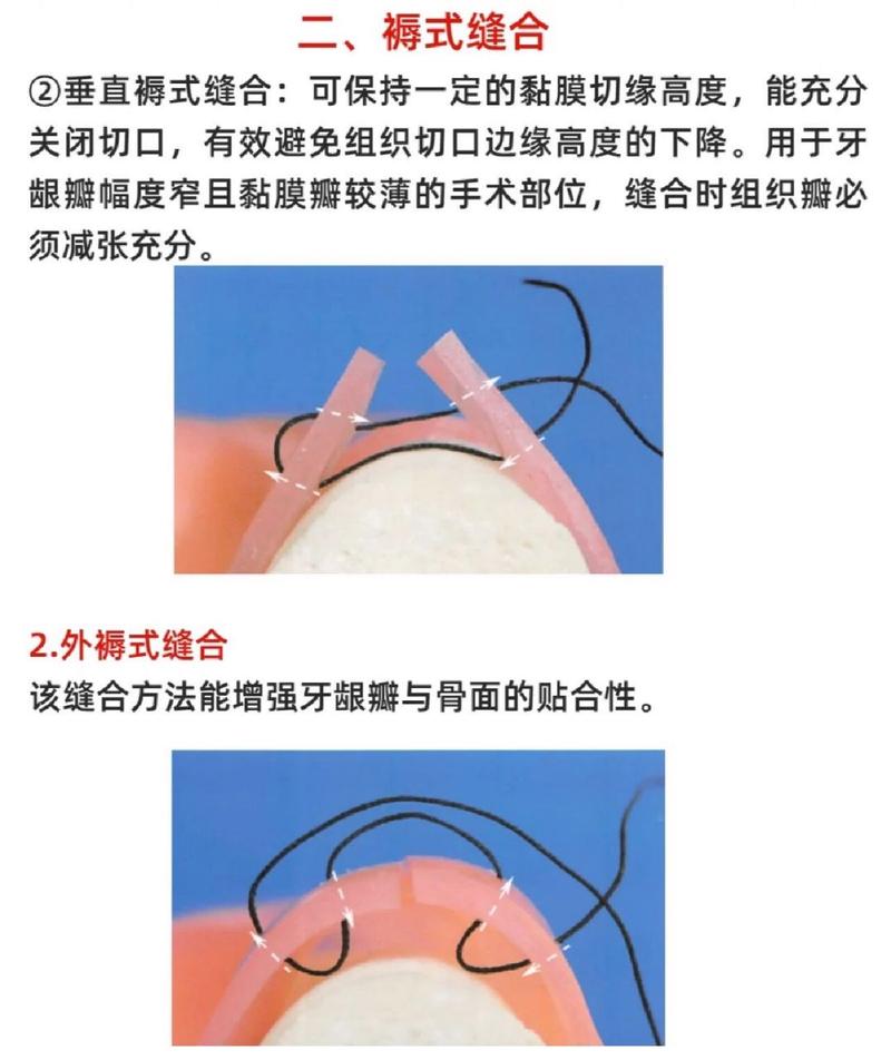 口内缝合打结如何规范操作？方法与技巧详解-图1