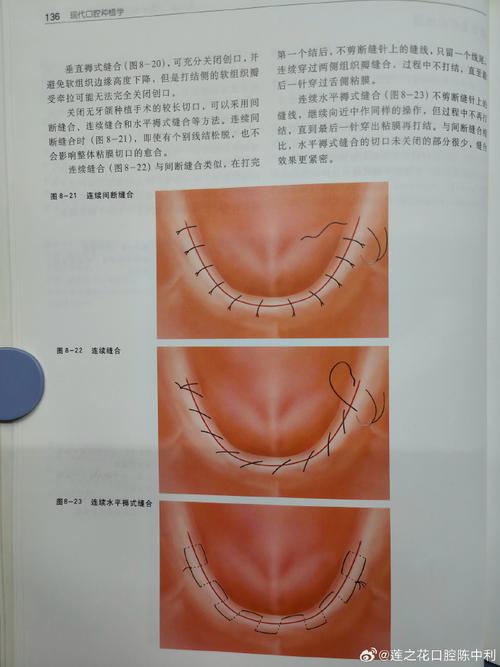 口内缝合打结如何规范操作？方法与技巧详解-图3