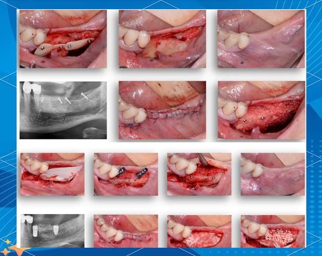 种牙填骨粉后出现该咋办？-图2
