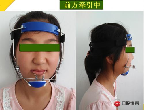 正畸面弓如何正确佩戴？操作步骤有哪些？-图1