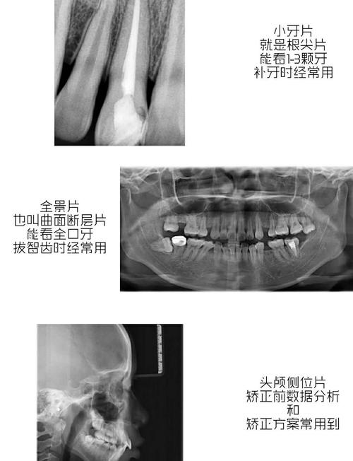 牙片CT拍摄方法-图2