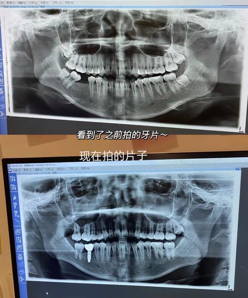 牙片CT拍摄方法-图3