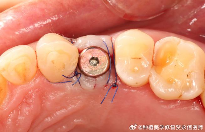 口腔种牙基台图片通常包含哪些类型和特点？-图2