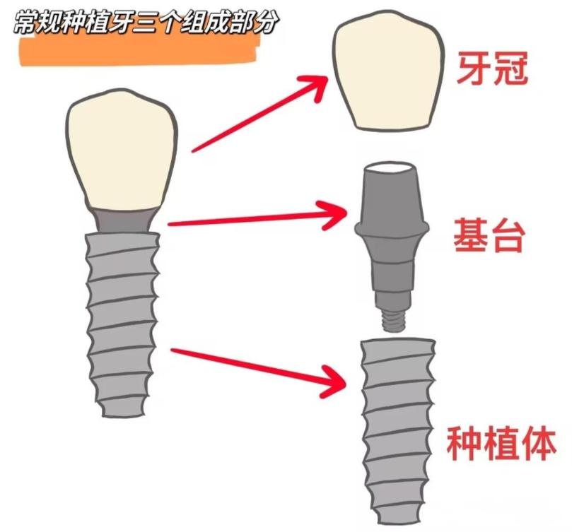口腔种牙基台图片通常包含哪些类型和特点？-图1
