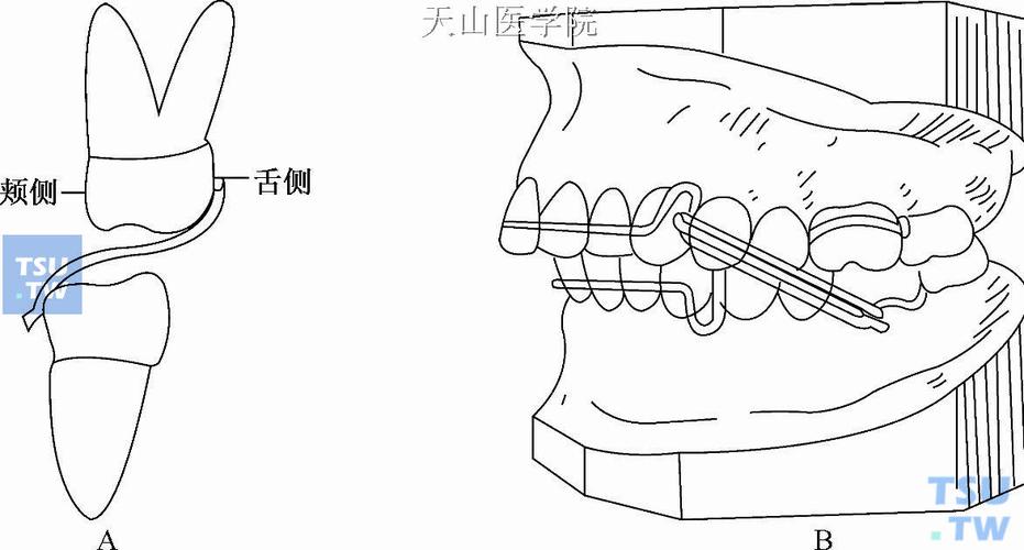 正畸支抗植入方法的选择与应用如何规范？-图1