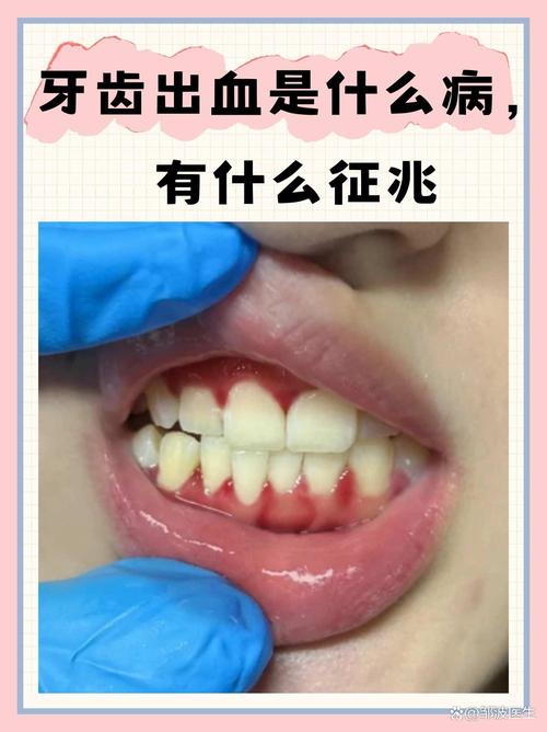 种牙术后口腔内出现血块属于正常术后反应吗？-图3