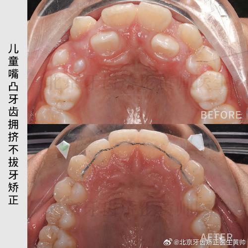 中线不齐正畸过程图片能看出哪些矫正进展？-图3