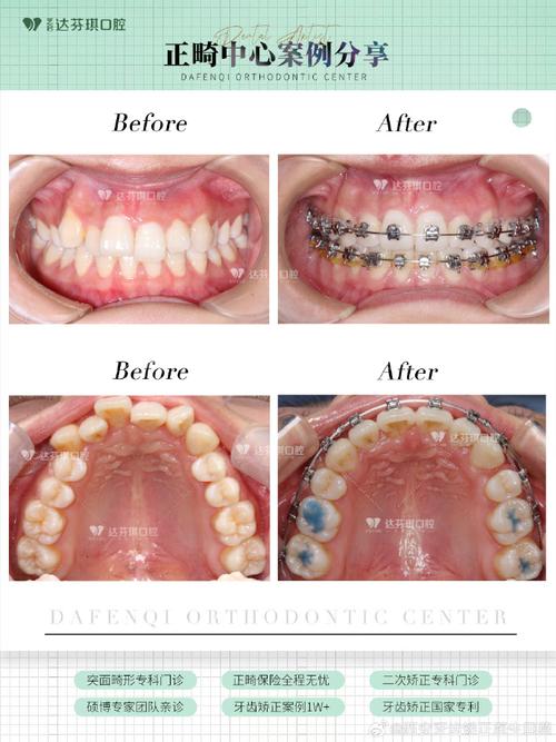 中线不齐正畸过程图片能看出哪些矫正进展？-图1