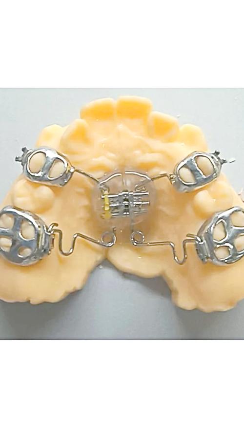 支抗磨牙后移的有效方法有哪些?-图1 支抗磨牙后移的有效方法有哪些?-图1