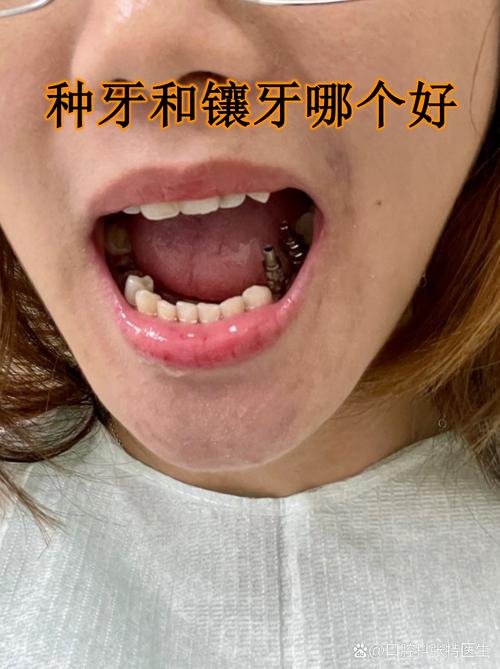 南京雅度口腔种牙效果怎样？医生技术靠谱吗？-图2