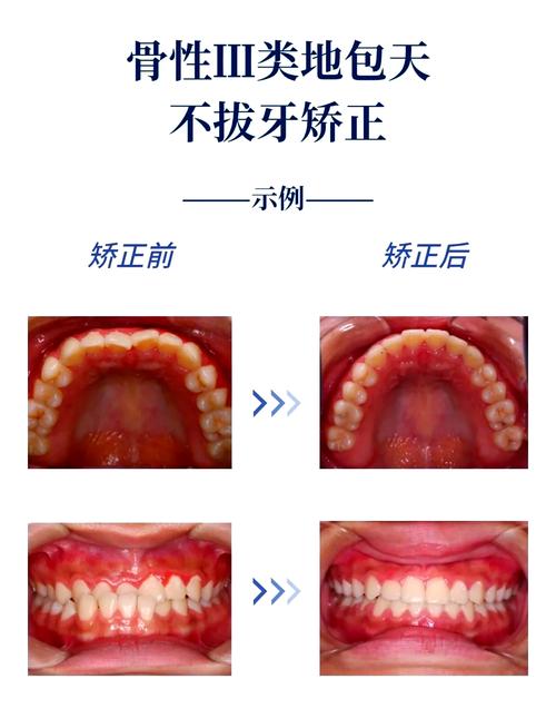 牙齿反合矫正有哪些常用有效的方法？-图3