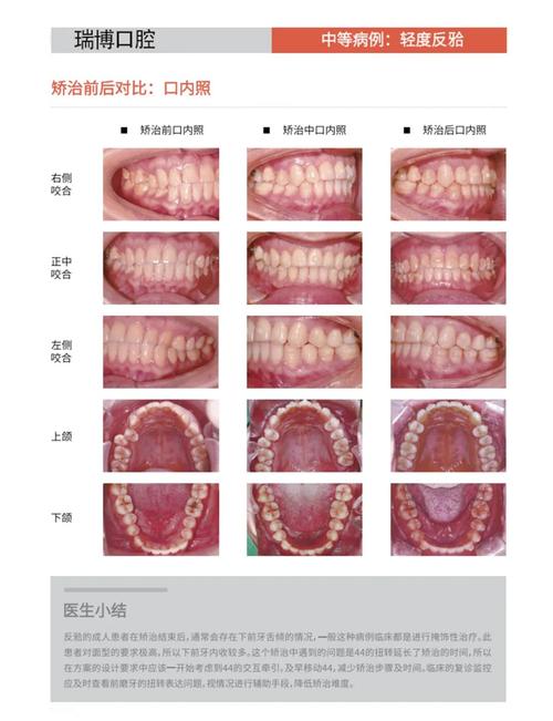 牙齿反合矫正有哪些常用有效的方法？-图1