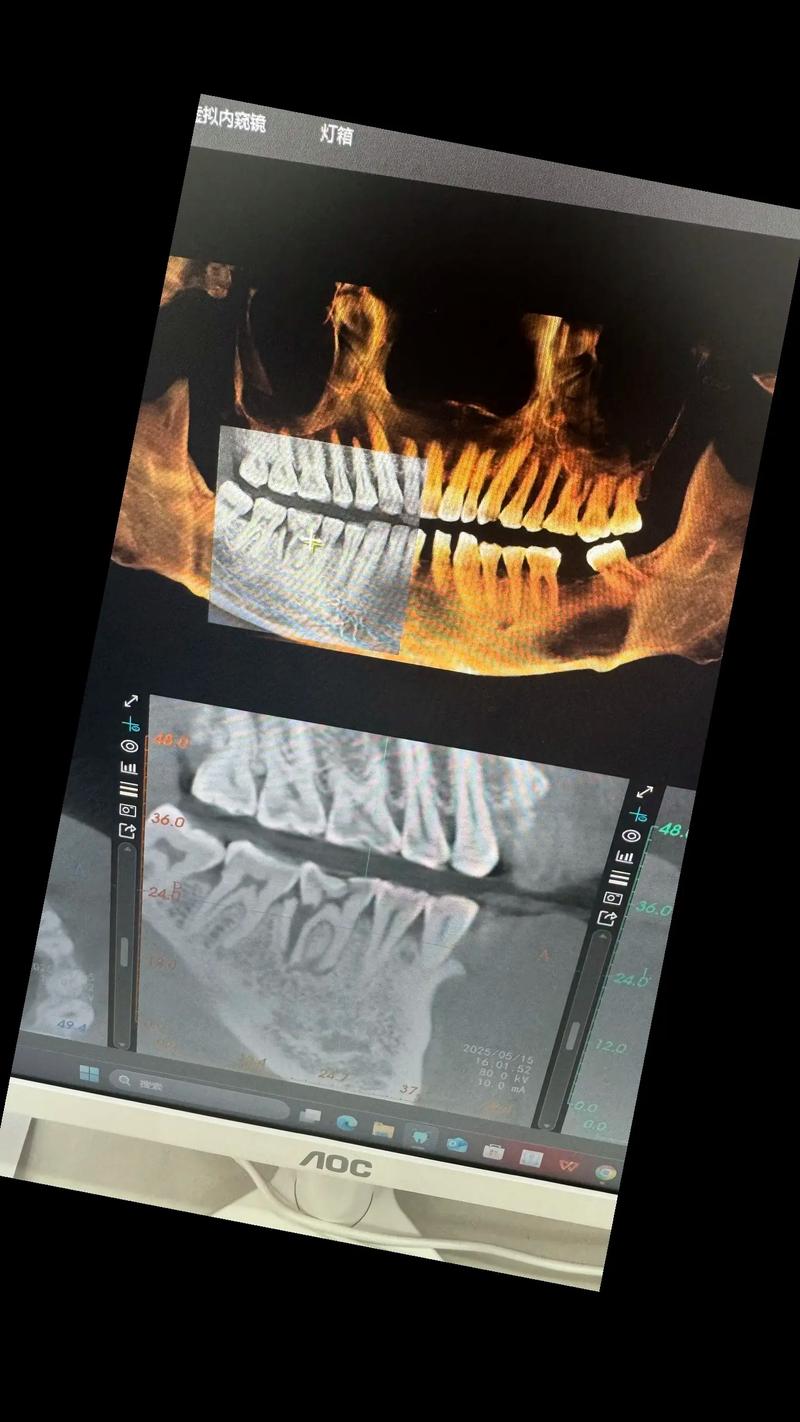 牙根摔掉后，还能通过种植牙修复吗？-图2