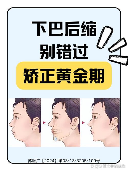 掩饰性正畸治疗后下巴变短是怎么回事？-图1