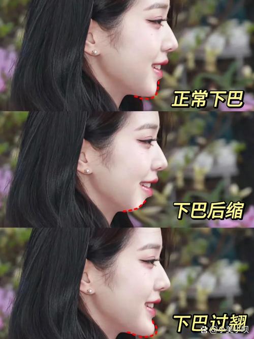 掩饰性正畸治疗后下巴变短是怎么回事？-图2