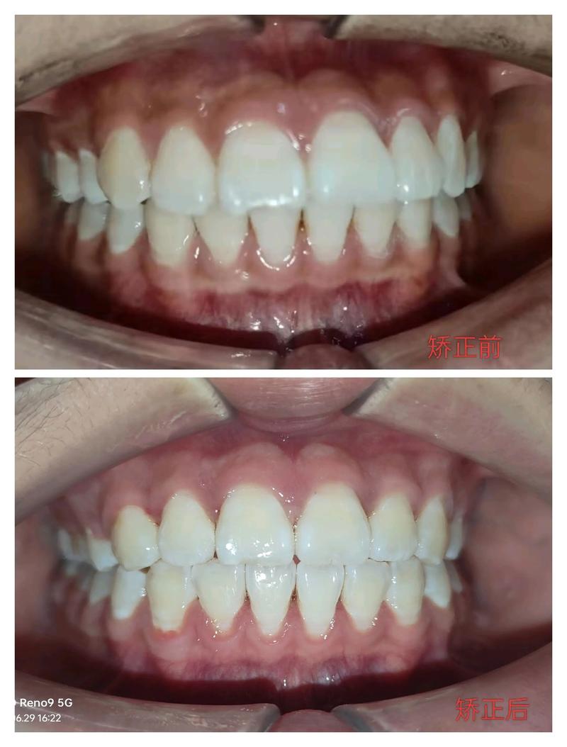 正畸前后侧面对比，脸型变化效果究竟有多大？-图2