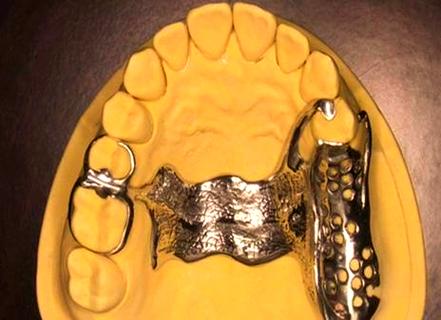 牙科支架制作方法的具体步骤和技术要点是什么？-图2