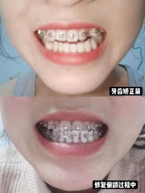 成都隐形正畸温馨春天，隐形正畸效果怎么样？-图3