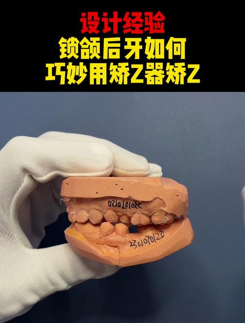 正畸锁颌治疗的最佳方法是什么？-图3