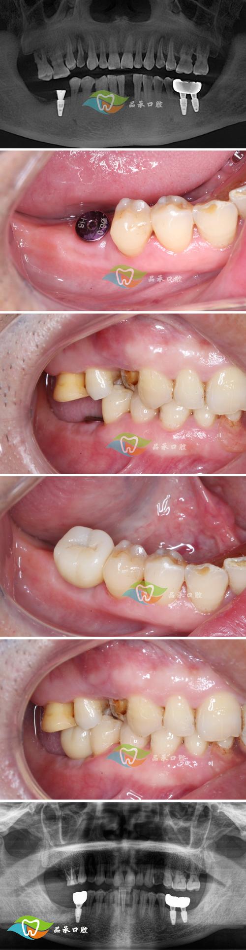 种牙后治疗步骤有哪些？-图3