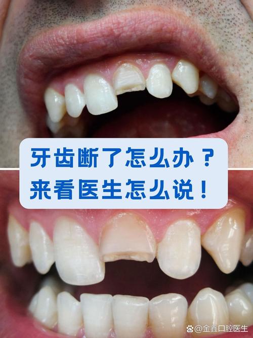 牙齿断了之后，种牙是必须的治疗方案吗？-图2