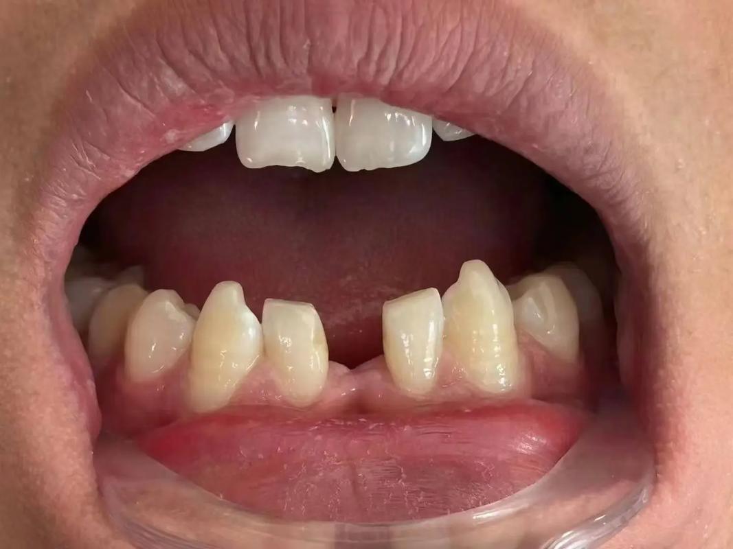 牙齿断了之后，种牙是必须的治疗方案吗？-图3