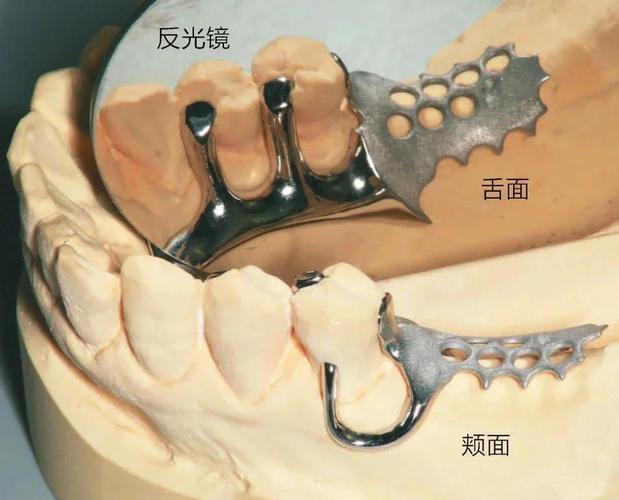 口腔正畸中卡环图片包含哪些常见类型及作用？-图3
