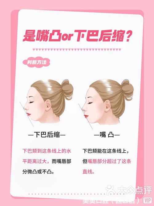 下颌后缩矫正方法有哪些？哪种更有效？-图2