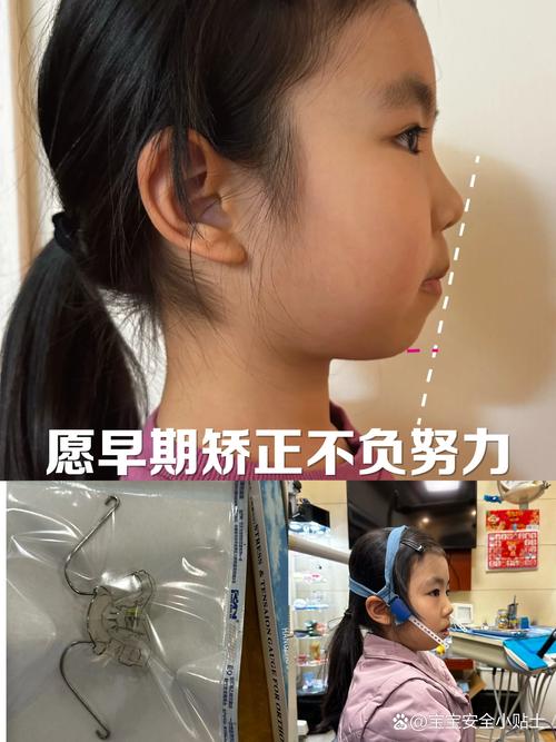 儿童偏颌矫正方法有哪些?如何科学选择?-图1 儿童偏颌矫正方法有哪些?如何科学选择?-图1