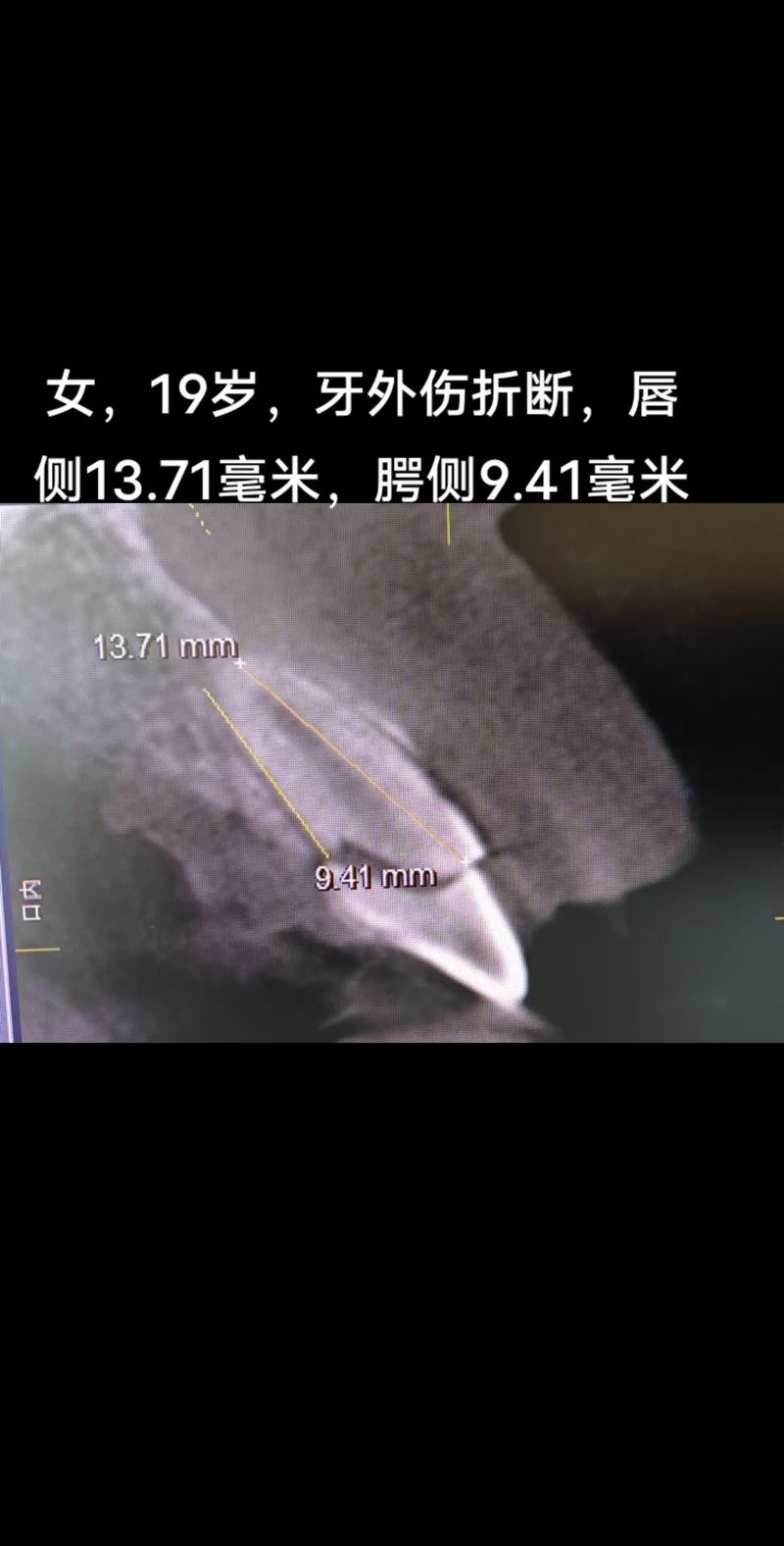 牙断了，种牙还是修补？哪种方式更适合你？-图3