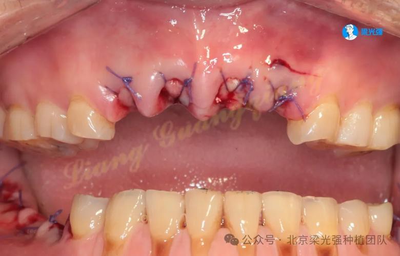 种牙失败后，身体和口腔会出现哪些问题？-图2