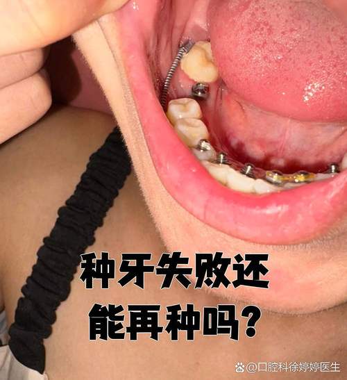 种牙失败后，身体和口腔会出现哪些问题？-图1