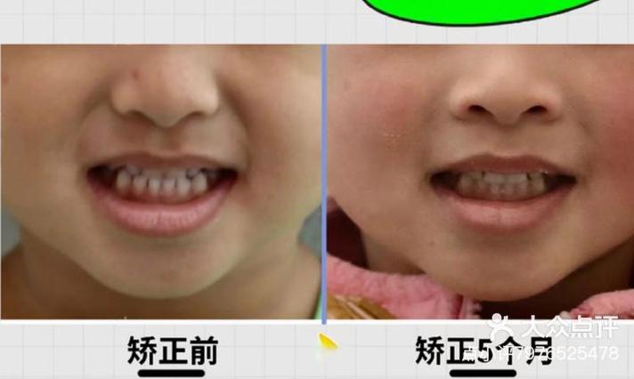 儿童兜齿矫正方法有哪些?家长该如何选择?-图3 儿童兜齿矫正方法有哪些?家长该如何选择?-图3