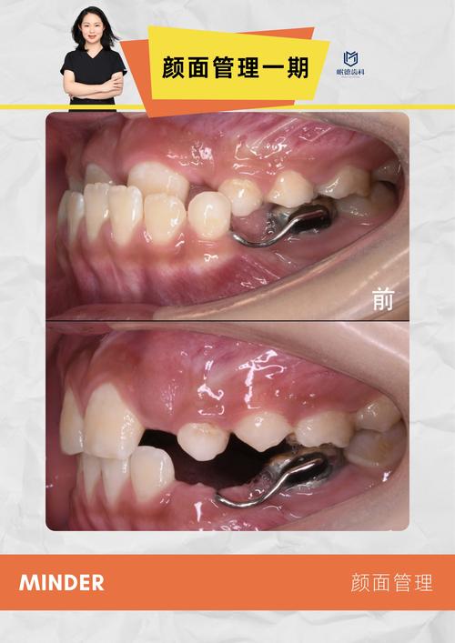 儿童兜齿矫正方法有哪些?家长该如何选择?-图2 儿童兜齿矫正方法有哪些?家长该如何选择?-图2