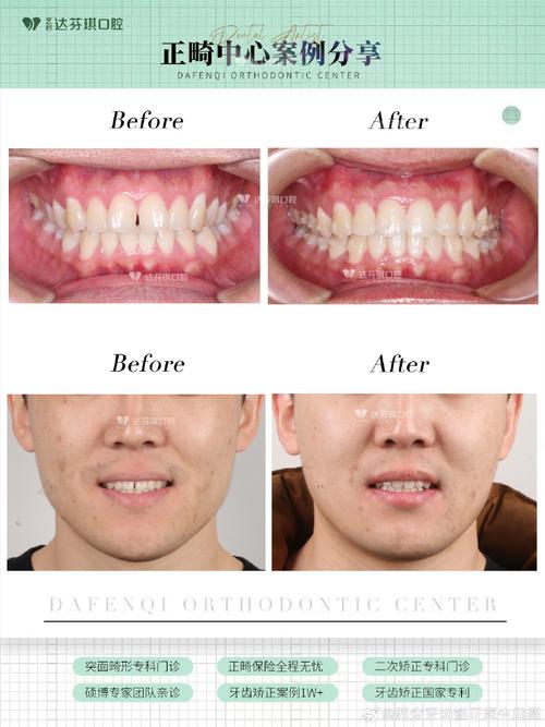 正畸期间门牙出现牙缝，是正常现象吗？-图3