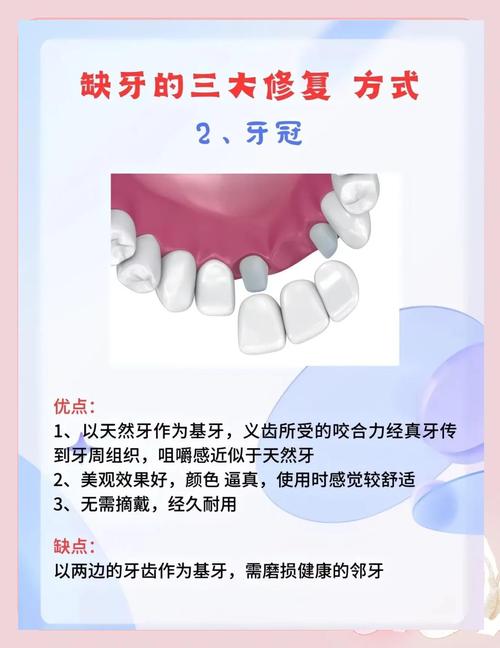 槽牙缺失修复方法怎么选?哪种更适合日常需求?-图2 槽牙缺失修复方法怎么选?哪种更适合日常需求?-图2