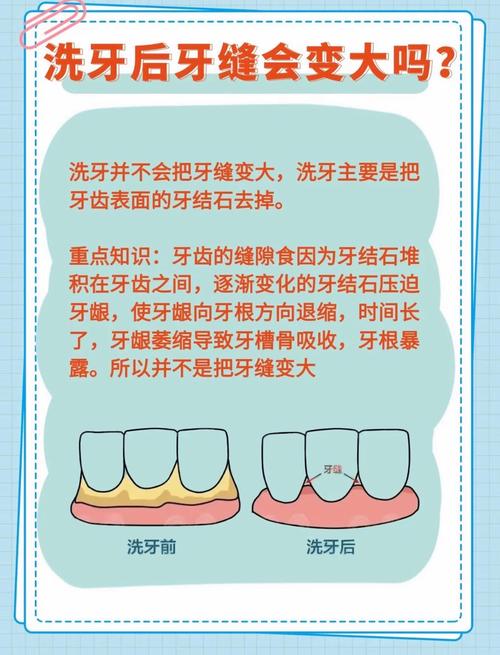 洗牙都有哪些方法？常见洗牙方式有几种？-图2